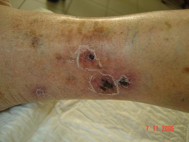 TUBERCULOSIS - TUBERCULOSIS -