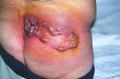 MALIGNANT LESIONS - Squamous Cell Carcinoma (SCC)