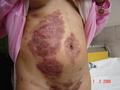 BULLOUS DISEASES - Pemphigus vulgaris