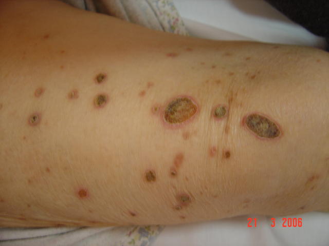 ΜΕΤΑΒΟΛΙΚΑ και ΔΙΑΤΡΟΦΙΚΑ ΝΟΣΗΜΑΤΑ - Perforating dermatosis (aquired reactive)