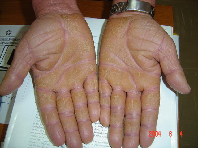 KERATINISATION DISORDERS - Pityriasis rubra pilaris