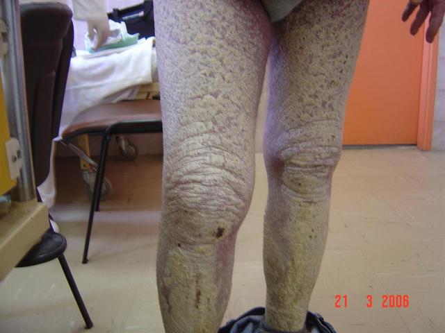 PSORIASIS - Psoriasis, Generalised 'en plaques' PSORIASIS - Psoriasis, Generalised 'en plaques'