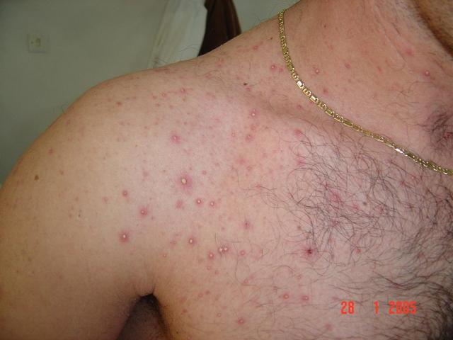 SUPERFICIAL FUNGAL INFECTIONS - Pityrosporum folliculitis SUPERFICIAL FUNGAL INFECTIONS - Pityrosporum folliculitis