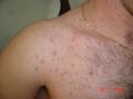 SUPERFICIAL FUNGAL INFECTIONS - Pityrosporum folliculitis