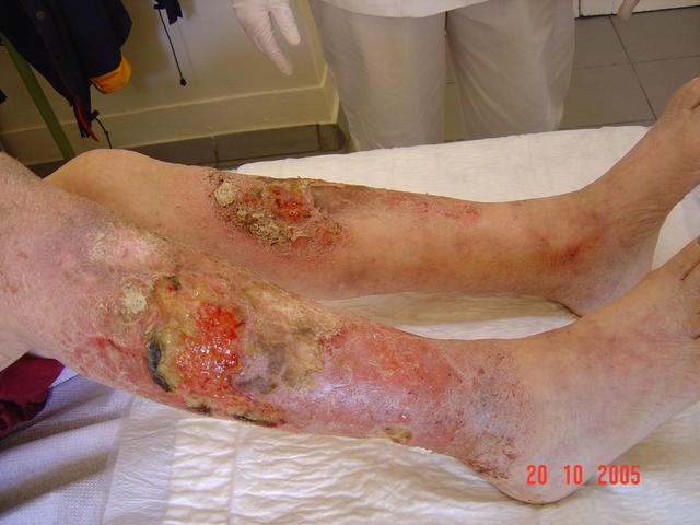 DISEASE OF THE BLOOD AND THE VESSELS – PURPURAS - Leg ulcers