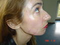 FACTICIAL LESIONS - Chemical peeling adverse reaction