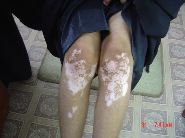  - Vitiligo