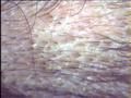 HAIR DISEASES - Alopecia Areata