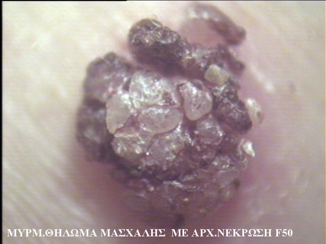 BENIGN SKIN LESIONS, NEVI, CYSTS - Skin tags BENIGN SKIN LESIONS, NEVI, CYSTS - Skin tags