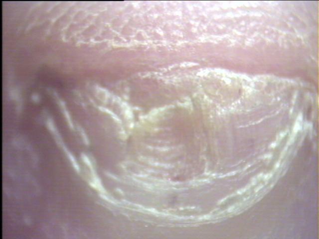 FACTICIAL LESIONS - Factitious lesions in a neurotic patient