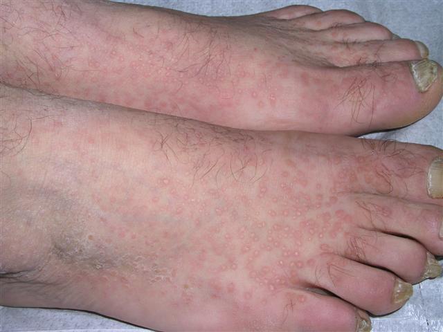 GENODERMATOSES - Acrokeratosis verruciformis of Hopf