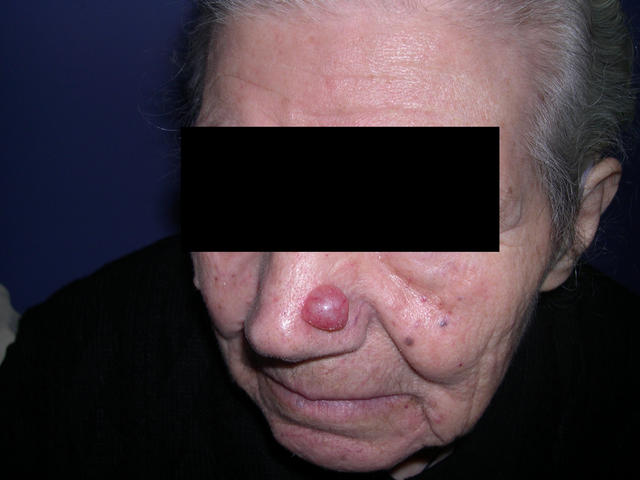 MALIGNANT LESIONS - Basal Cell Carcinoma, cystic