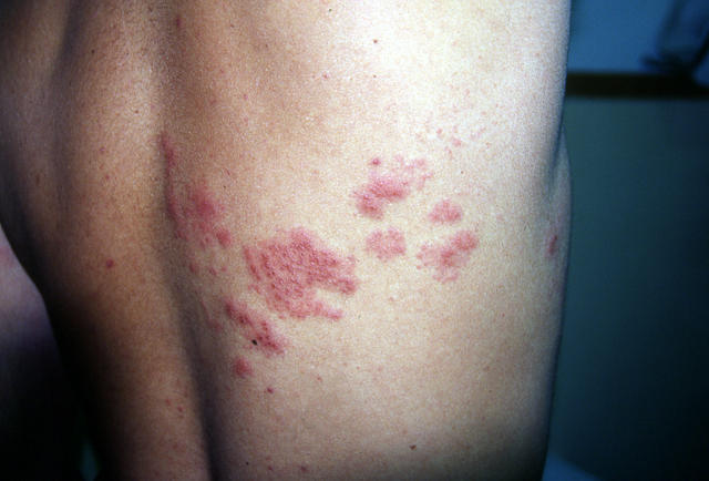VIRAL INFECTIONS - Herpes Zoster VIRAL INFECTIONS - Herpes Zoster