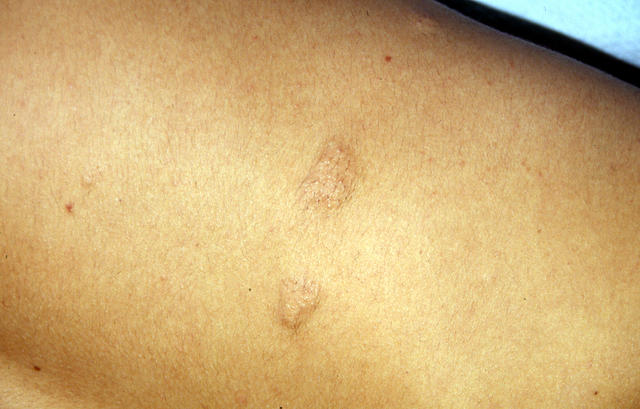 CONNECTIVE TISSUE DISORDERS - Anetoderma CONNECTIVE TISSUE DISORDERS - Anetoderma