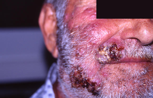 SUPERFICIAL FUNGAL INFECTIONS - Sycosis barbae due to dermatophyte infection