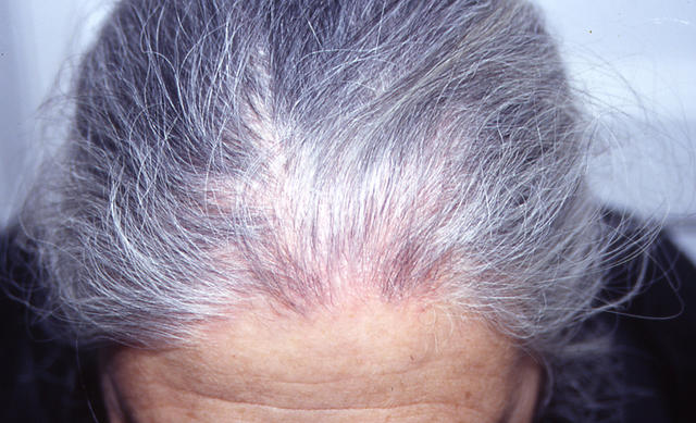 SUPERFICIAL FUNGAL INFECTIONS - Tinea capitis in an adult SUPERFICIAL FUNGAL INFECTIONS - Tinea capitis in an adult