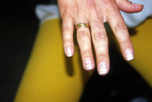 NAIL DISEASES - Leukonychia