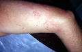 URTICARIA - Urticaria