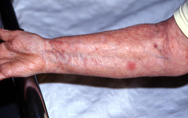 DRUG ERUPTIONS - Drug eruption DRUG ERUPTIONS - Drug eruption