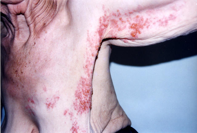 VIRAL INFECTIONS - Herpes Zoster