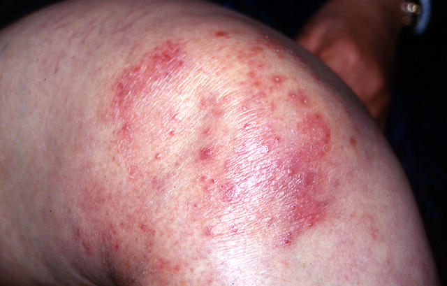 Superficial Fungal Infections Tinea Incognita Picture Hellenic