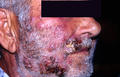 SUPERFICIAL FUNGAL INFECTIONS - Sycosis barbae due to dermatophyte infection