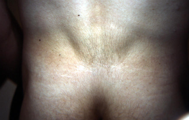 GENODERMATOSES - Tuberous sclerosis complex GENODERMATOSES - Tuberous sclerosis complex