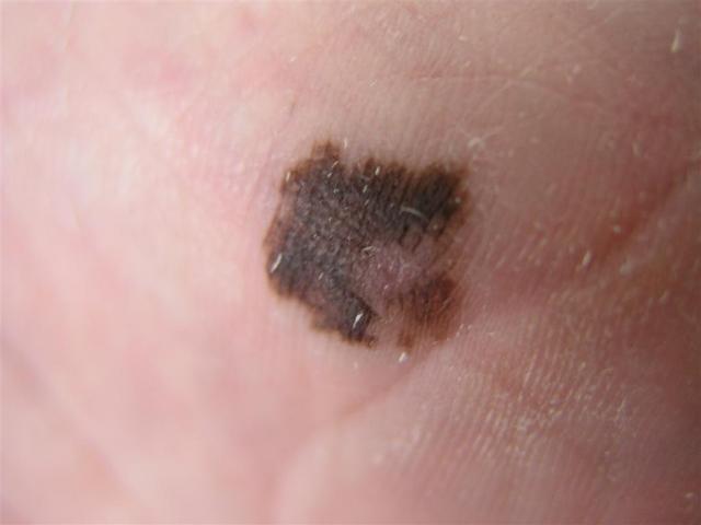 MALIGNANT LESIONS - Acral melanoma