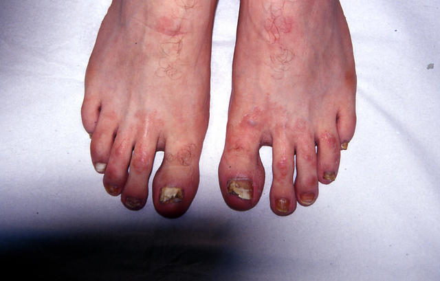 NAIL DISEASES - Onychomycosis