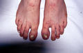 NAIL DISEASES - Onychomycosis