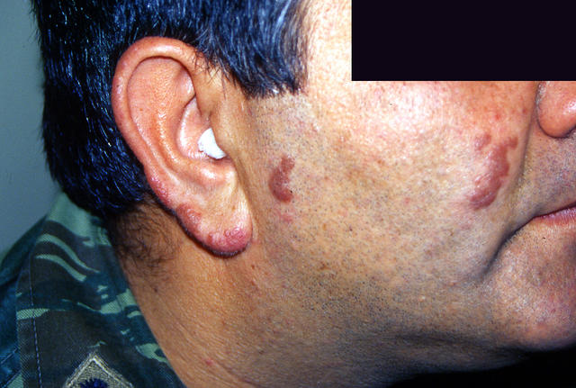 VARIOUS or of UNKNOWN ETIOLOGY DISEASES - Garnuloma faciale