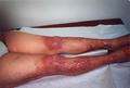 DERMATITIS - EKZEMA - Neurodermatitis