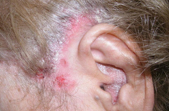 BULLOUS DISEASES - Psoriasis and bullous pemphigoid - Coexistence