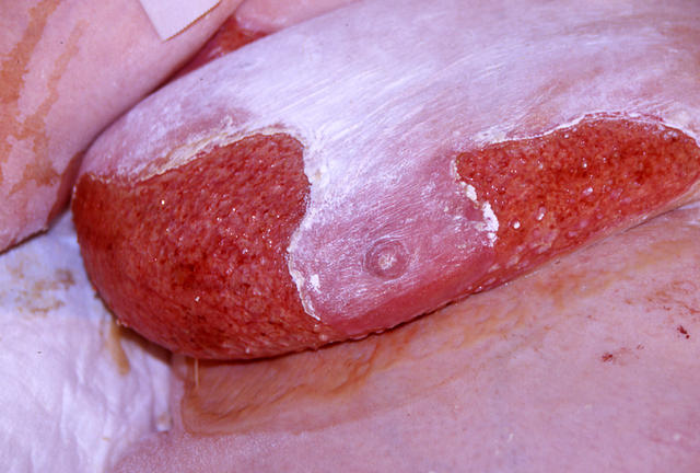 BULLOUS DISEASES - Pemphigus vulgaris