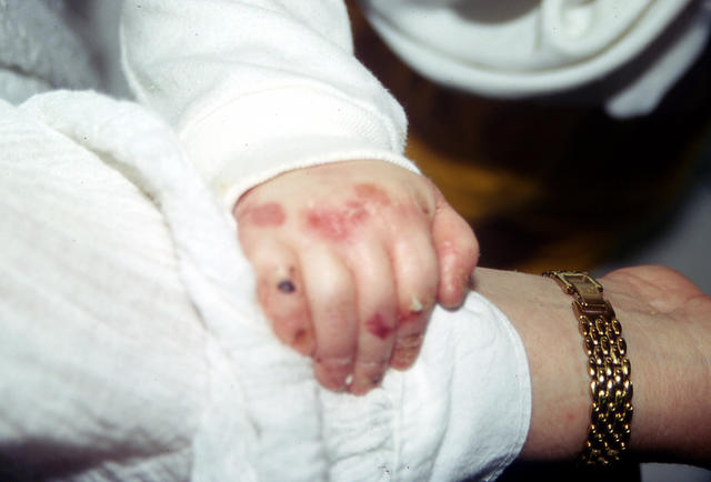 CONNECTIVE TISSUE DISORDERS - Epidermolysis bullosa aquisita CONNECTIVE TISSUE DISORDERS - Epidermolysis bullosa aquisita