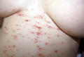 SKIN DISEASES IN PREGNANCY - Herpes gestationis