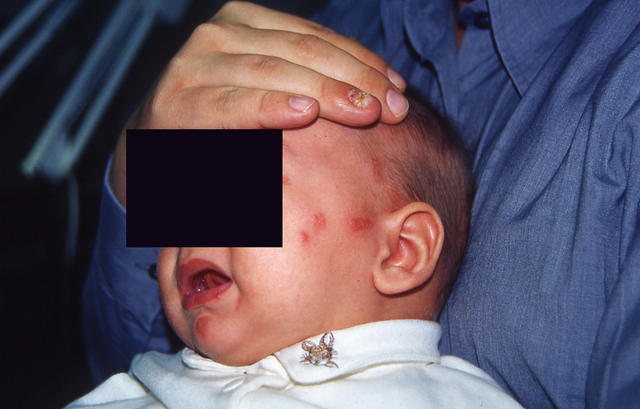 VIRAL INFECTIONS - Herpes Zoster VIRAL INFECTIONS - Herpes Zoster