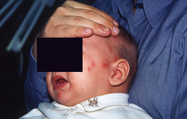 VIRAL INFECTIONS - Herpes Zoster