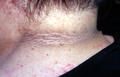 KERATINISATION DISORDERS - Acanthosis nigricans