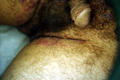 BACTERIAL INFECTIONS - Impetigo