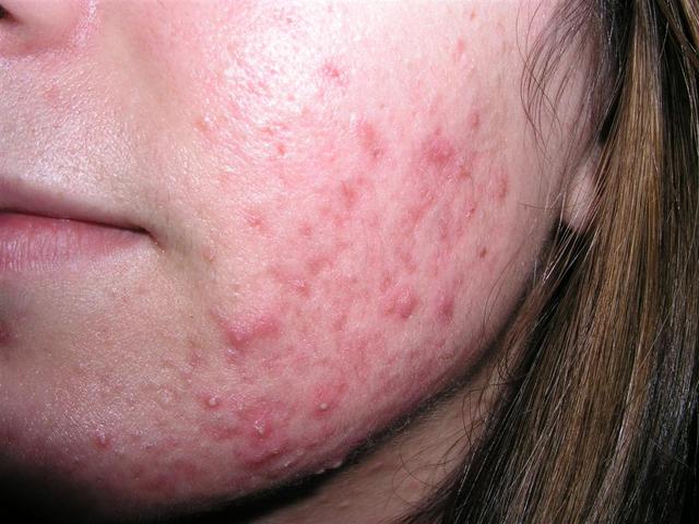 DISEASES OF THE SEBACEOUS GLANDS - Acne, inflammatory of the face DISEASES OF THE SEBACEOUS GLANDS - Acne, inflammatory of the face