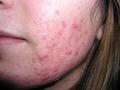 DISEASES OF THE SEBACEOUS GLANDS - Acne, inflammatory of the face