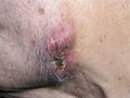 METASTATIC LESIONS - Lung cancer, metastases
