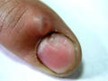 NAIL DISEASES - Mucous Cyst
