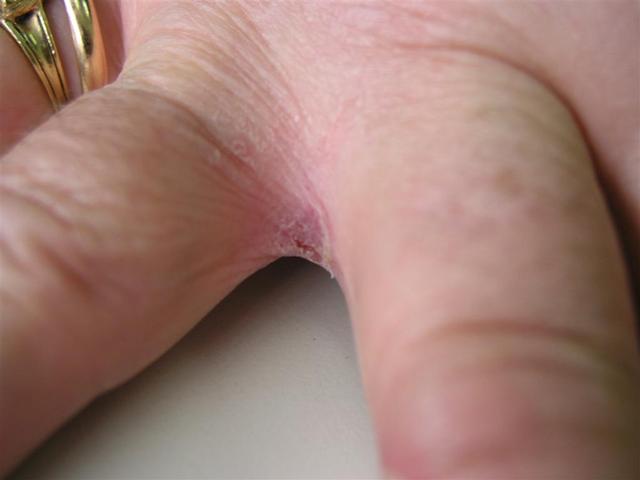 SUPERFICIAL FUNGAL INFECTIONS - Candidiasis SUPERFICIAL FUNGAL INFECTIONS - Candidiasis