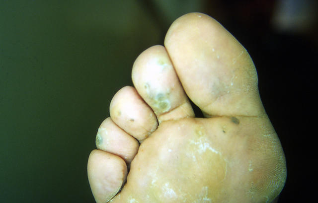 VIRAL INFECTIONS - Plantar warts