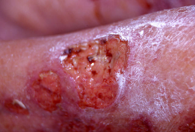 BULLOUS DISEASES - Pemphigus vulgaris BULLOUS DISEASES - Pemphigus vulgaris