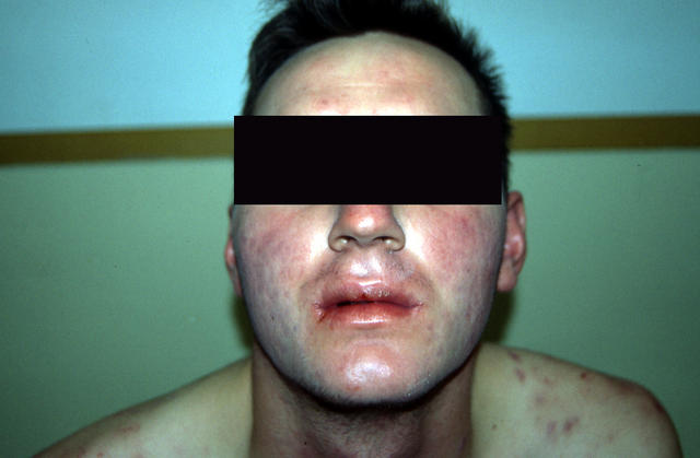 DISEASES OF THE SEBACEOUS GLANDS - Acne, inflammatory DISEASES OF THE SEBACEOUS GLANDS - Acne, inflammatory