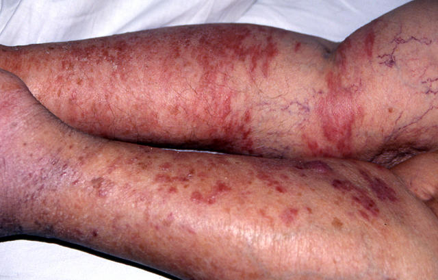 SOFT TISSUE TUMORS - Kaposi sarcoma SOFT TISSUE TUMORS - Kaposi sarcoma