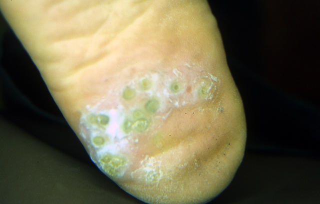 VIRAL INFECTIONS - Plantar warts